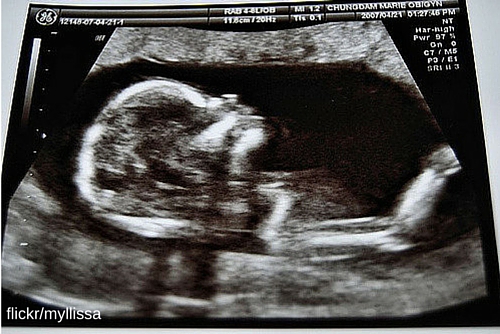 Blind mom “Sees” Her Unborn Baby (Video)!